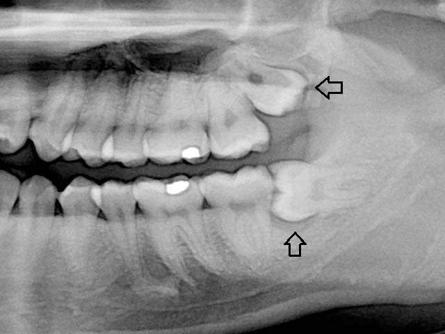Radiografía dental periapical de las muelas del juicio.