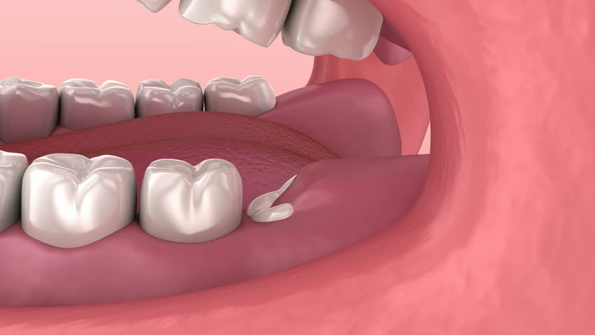 Las muelas del juicio mueven los dientes por varios factores.